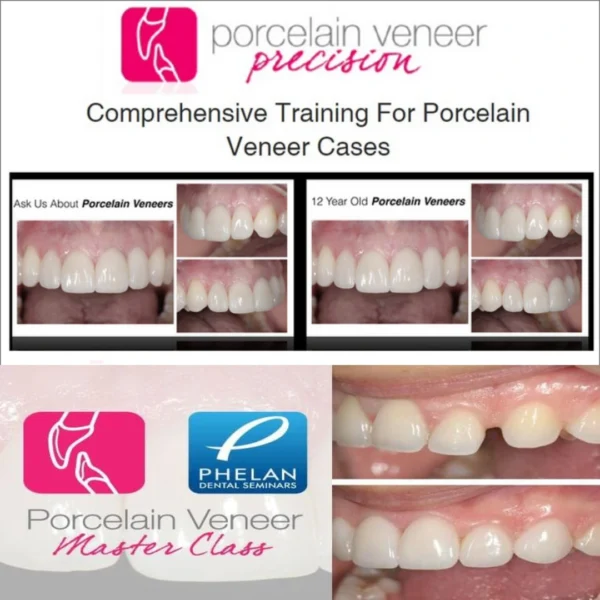 Porcelain Veneer Precision Comprehensive Training for Porcelain Veneer Cases Porcelain Veneer Precision: Comprehensive Training for Porcelain Veneer Cases