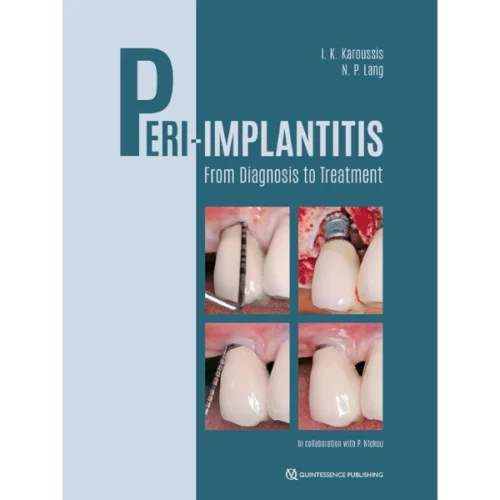 Peri-Implantitis: From Diagnosis to Treatment