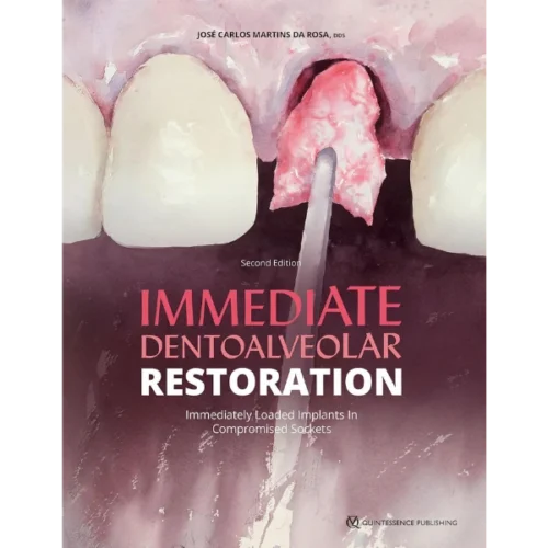 Immediate Dentoalveolar Restoration: Immediately Loaded Implants in Compromised Sockets