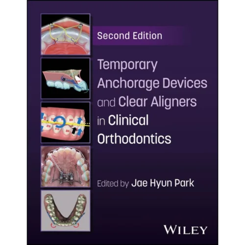 Temporary Anchorage Devices and Clear Aligners in Clinical Orthodontics