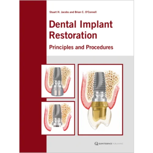Dental Implant Restoration Principles and Procedures